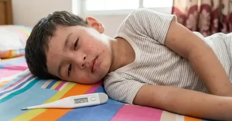 হাম রোগের লক্ষণ বাংলাদেশ