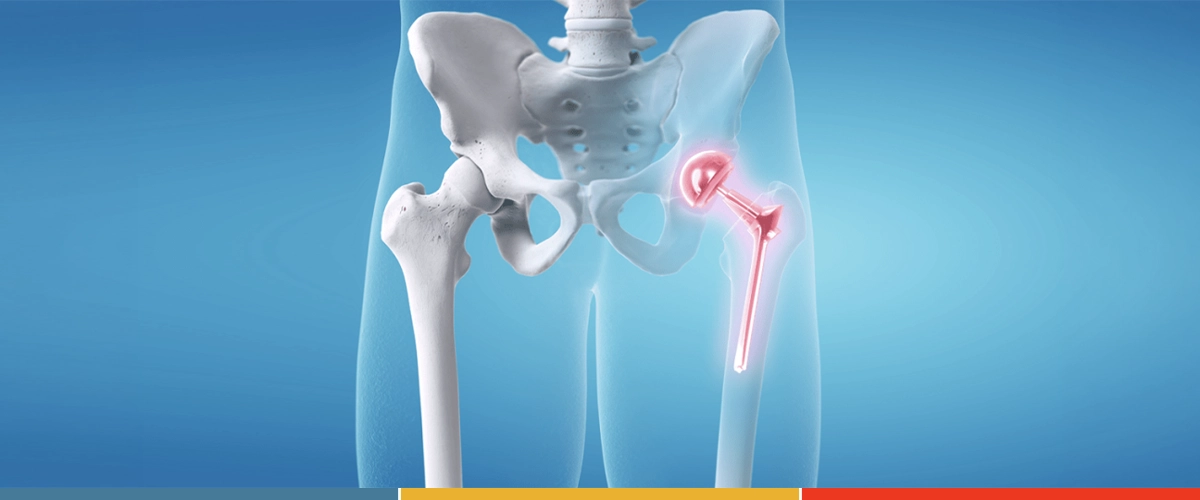 Hip Replacement
